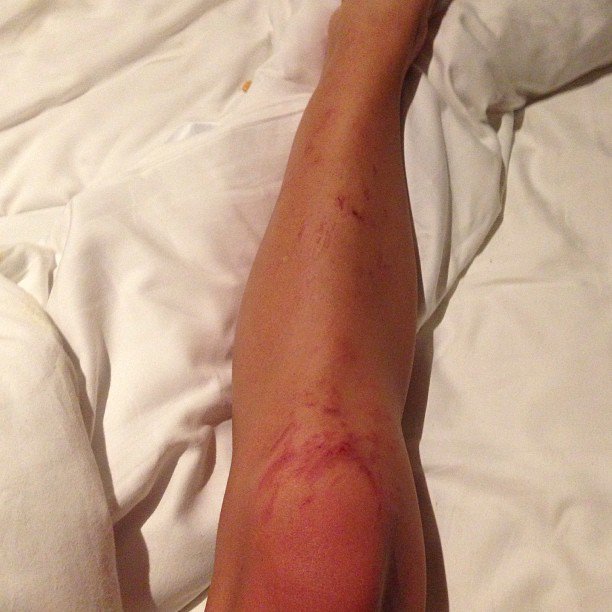 Ashley Greene showcases a surf injury from Bali on Instagram, bravely captioning it, "War wound from today's surf with Oakley. The reef ate me up. #worthit"