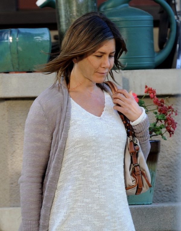 Large scars cover parts of Jennifer's neck and face