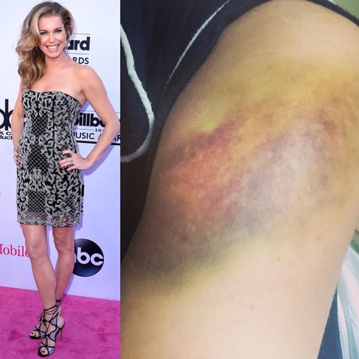 Despite a large, colorful bruise on her thigh, Rebecca Romijn radiated confidence and elegance on the 2016 Billboard Music Awards red carpet, thanks to her makeup artist Karan Mitchell's exceptional work in concealing the injury