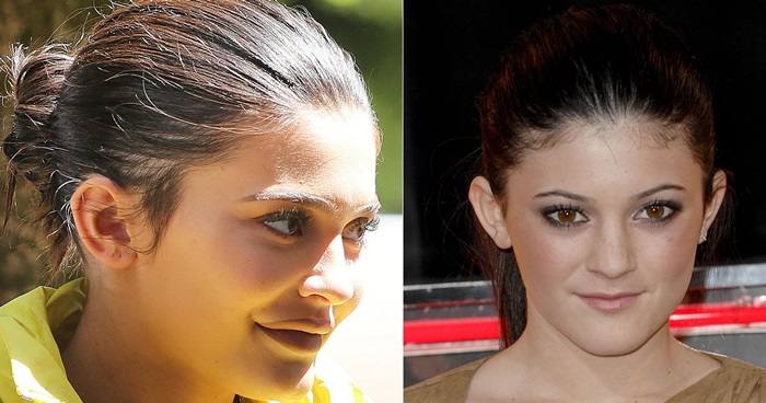Kylie Jenner’s lips before and after her fuller lip era, a transformation she has attributed to lip fillers