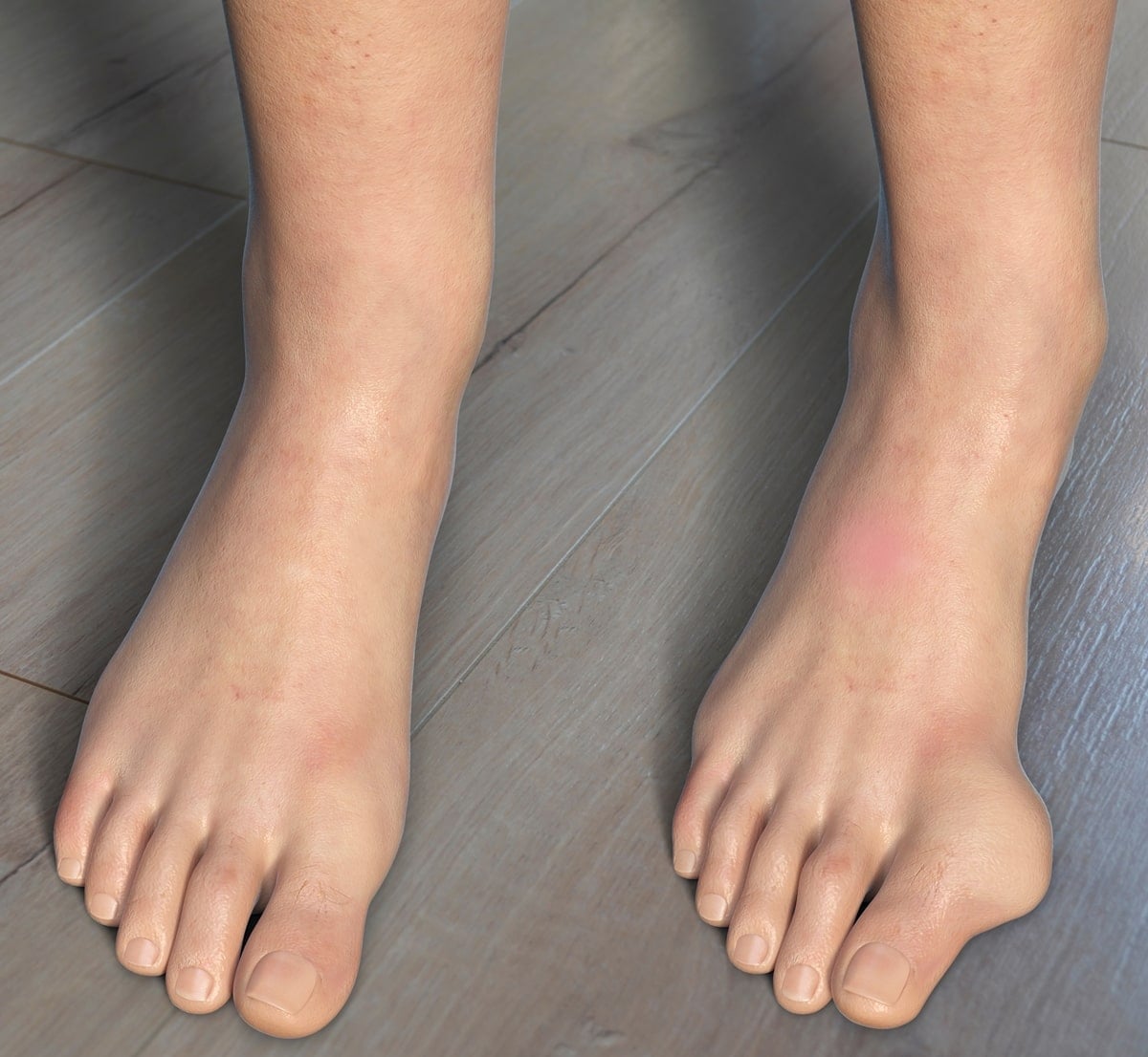 While the exact cause of bunions remains uncertain, many podiatrists point to high heels as a contributing factor due to the prolonged pressure they place on the toes and the forefoot