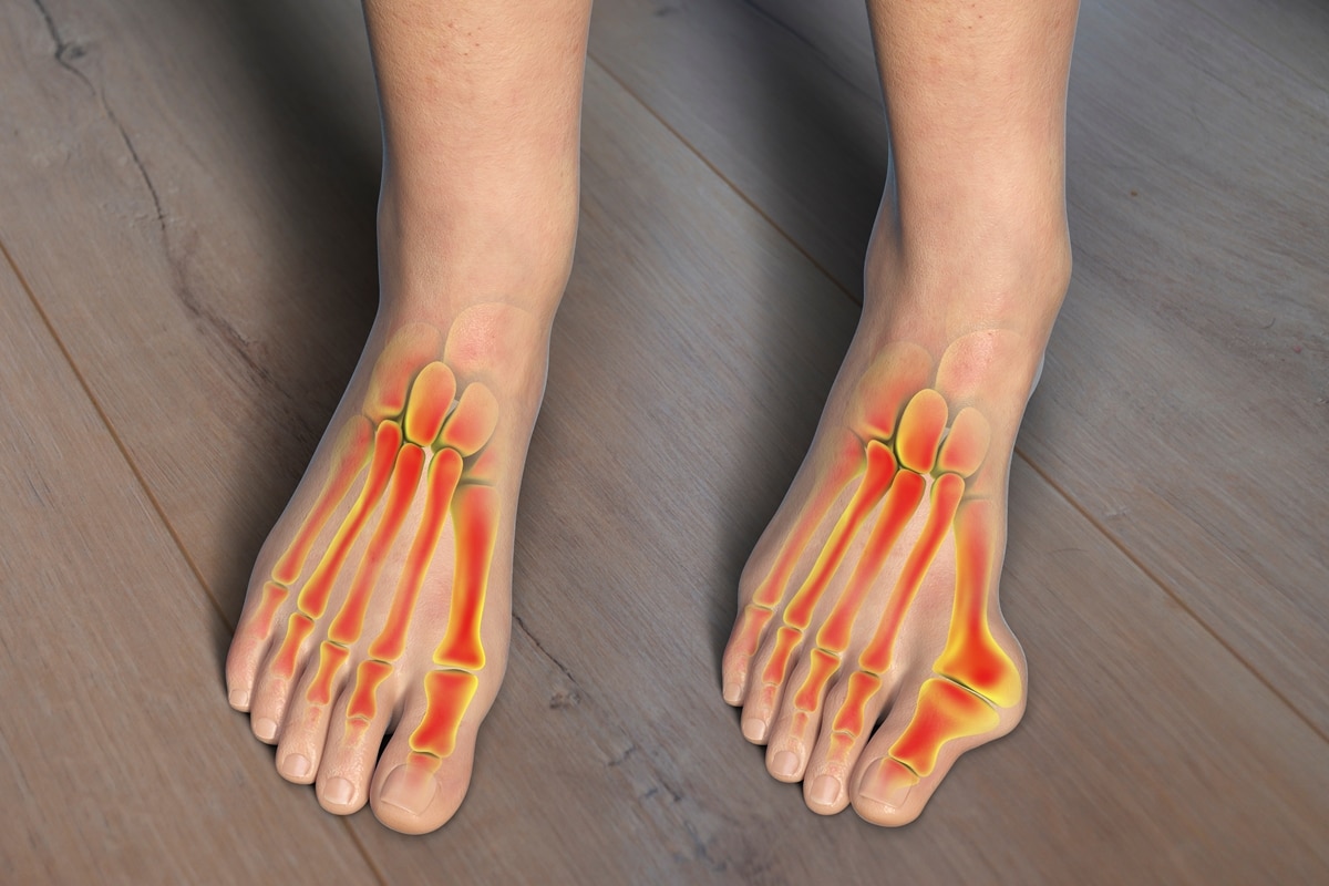 Comparison of a normal foot (left) and a foot with a bunion (right), showing the bony bump at the big toe joint, causing misalignment and inflammation