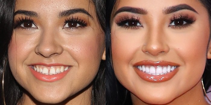 Becky G showcases her transformation with a signature tooth gap (left) compared to her flawless smile after veneers (right)