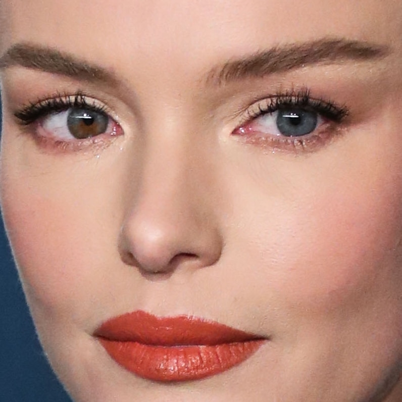 Kate Bosworth is perhaps the most famous celebrity with heterochromia