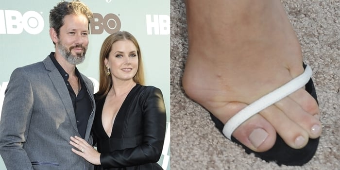 Amy Adams shows off a chic look on the red carpet, while a close-up of her foot highlights a visible bunion, a common foot issue often caused by wearing high heels