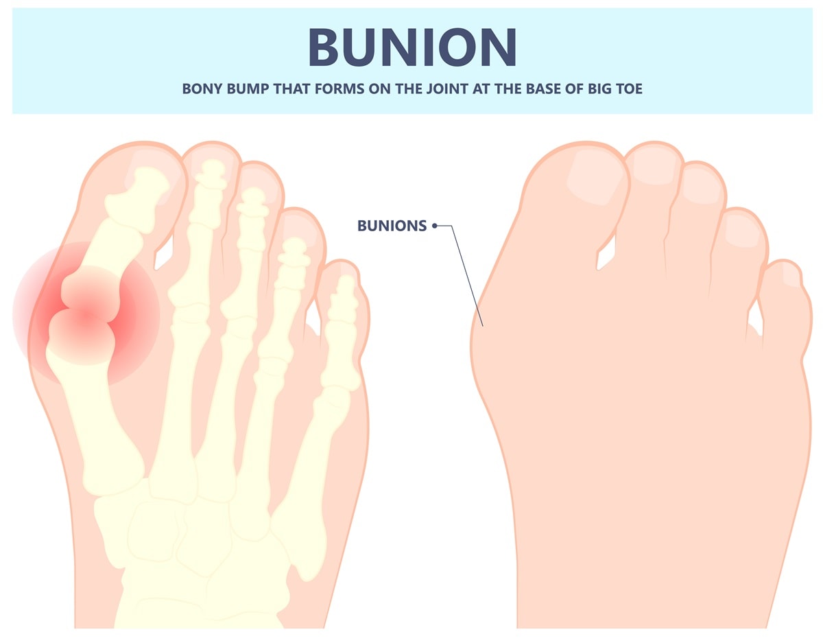 A bunion is a painful bony bump that forms on the inside of the foot around the joint of your big toe