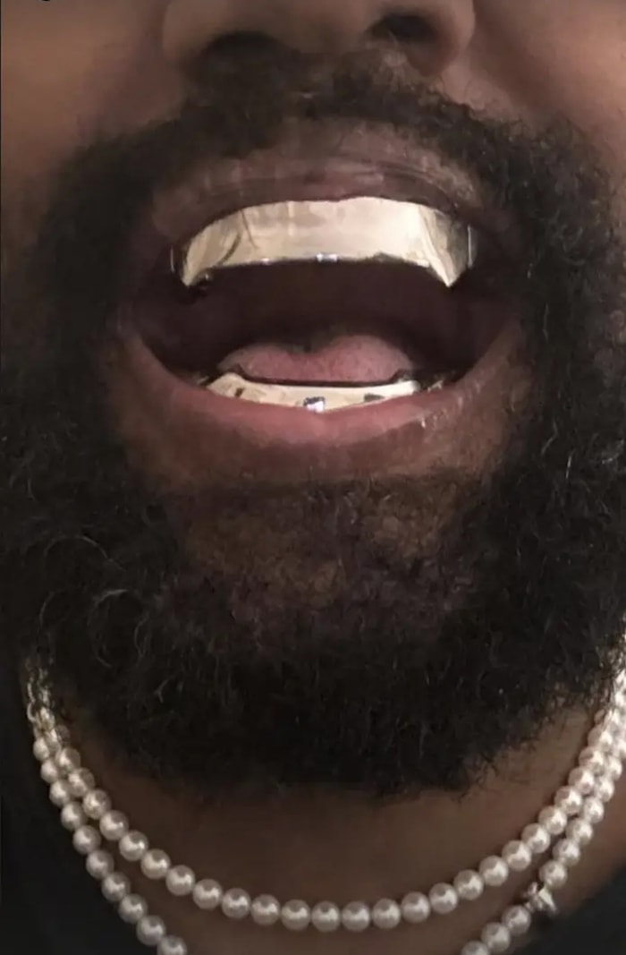 Kanye West shows off his new $850,000 titanium teeth